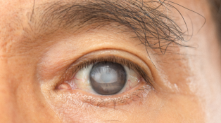 18_Aug_Cataract
