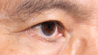 cataract