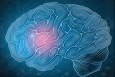 Stroke ICP Programme