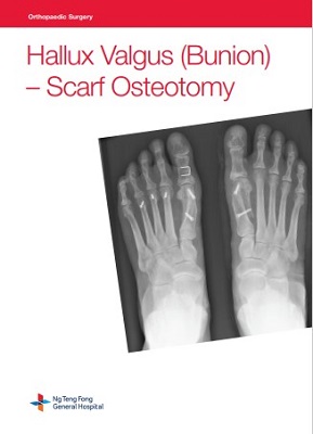 Hallux Valgus (Bunion) - Scarf Osteotomy
