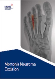 Morton’s Neuroma Excision