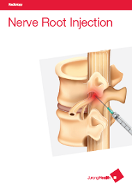 Nerve Root Injection
