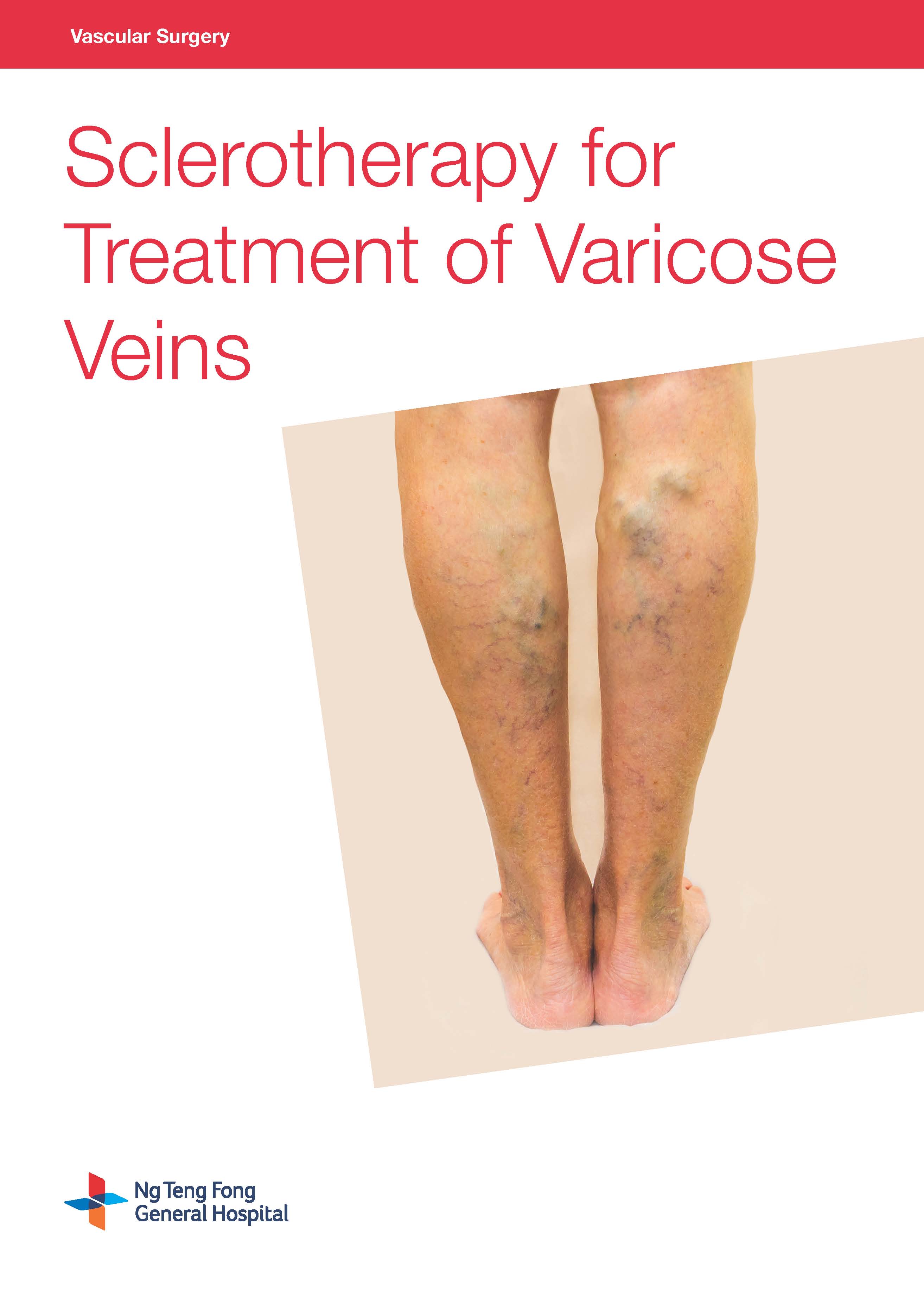 Sclerotherapy for Treatment of Varicose Veins